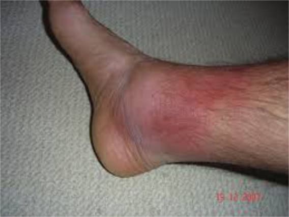 Erysipeloid skin rashes in Familial Mediterranean Fever.