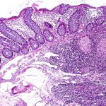 Crohn's colitis biopsy specimen.