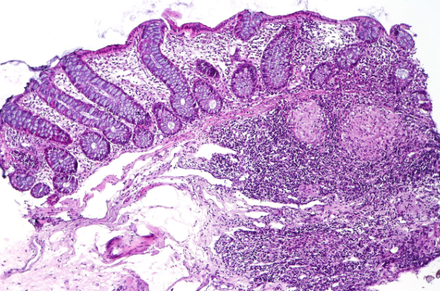 Crohn's colitis biopsy specimen.