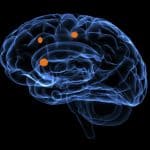 Brain metastasis, illustration.
