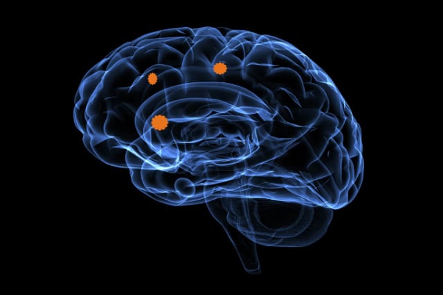 Brain metastasis, illustration.