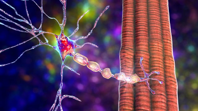 Illustration of a demyelinated neuron in multiple sclerosis, an autoimmune disease.
