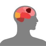 Brain tumor illustration.