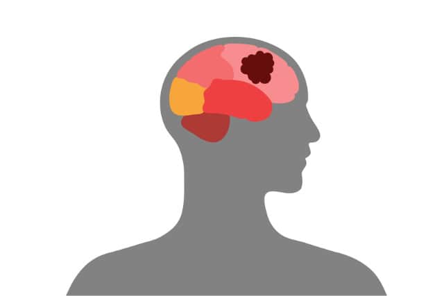 Brain tumor illustration.