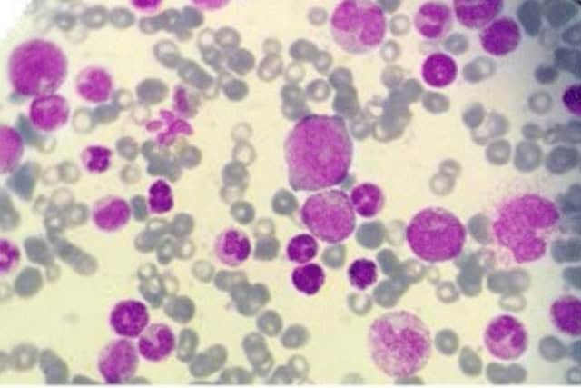 Myelogram of patient with a myeloproliferative disorder.