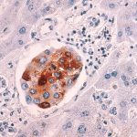 Breast cancer metastasis to liver.