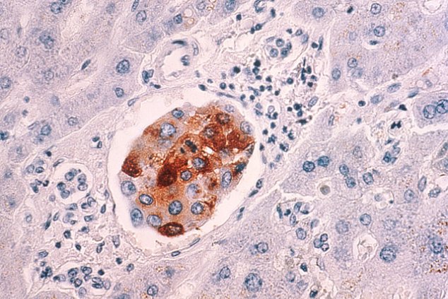 Breast cancer metastasis to liver.