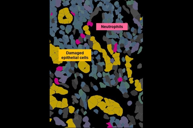 Neutrophil–epithelial niches in the kidney in ANCA-associated vasculitis (image).