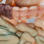 Colorectal cancer, 3D medical illustration.