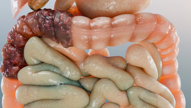Colorectal cancer, 3D medical illustration.